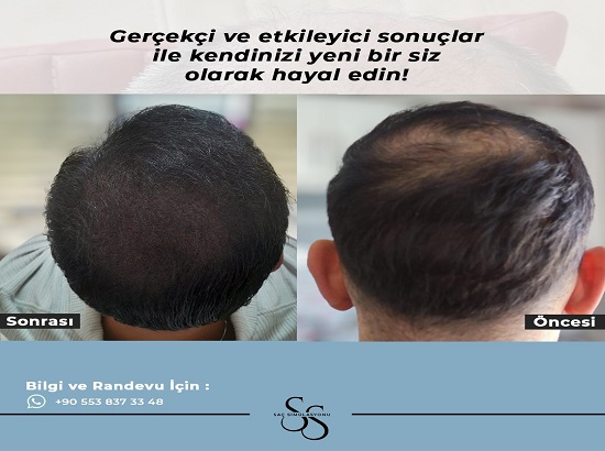 Bursa'da bulunan saç simülasyonu firmamız, saç kaybıyla mücadele eden bireylere doğal ve güvenilir çözümler sunmaktadır. Son teknoloji ürünü ekipmanlarımız ve uzman ekibimizle, her müşterimizin ihtiyaçlarına özel çözümler üretiyoruz.
